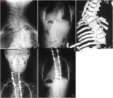 Représentation diagnostique élevée de la couverture X Ray d'encre, film médical de rayon de x de laser de 35 x de 43cm