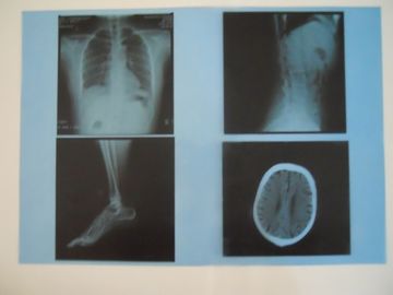 Bon prix Film sec médical de représentation de bas brouillard de KND-A pour l'examen de X Ray sur AGFA 5300/5302/5500 en ligne