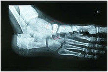 papier médical de représentation diagnostique dégradable de X Ray de 13in x de 17in pour l'imprimante à laser