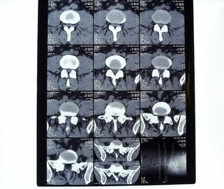 10in * 12in films secs d'imagerie médicale à haute densité de 11in * de 14in pour l'imprimante d'AGFA/Fuji